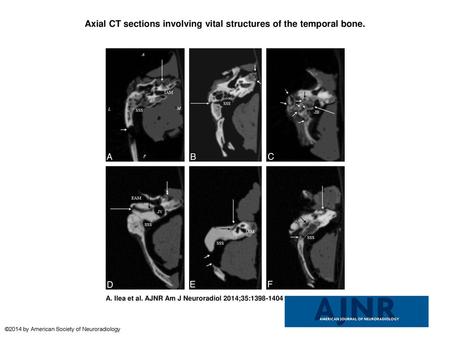 Axial CT sections involving vital structures of the temporal bone.