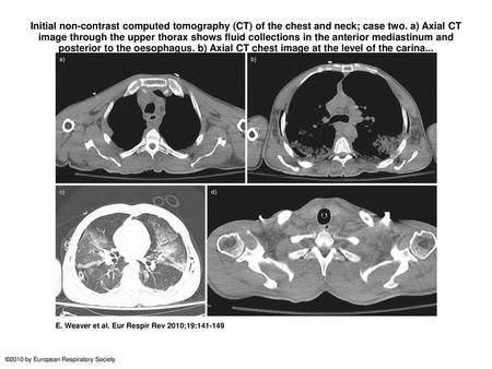 Initial non-contrast computed tomography (CT) of the chest and neck; case two. a) Axial CT image through the upper thorax shows fluid collections in the.