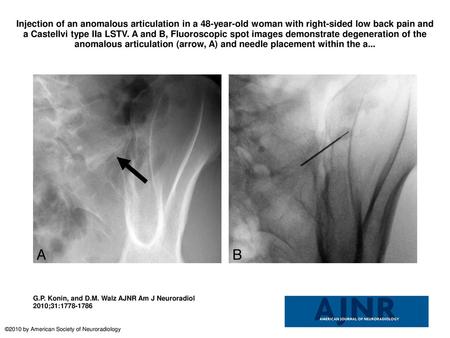 Injection of an anomalous articulation in a 48-year-old woman with right-sided low back pain and a Castellvi type IIa LSTV. A and B, Fluoroscopic spot.