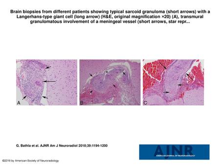 Brain biopsies from different patients showing typical sarcoid granuloma (short arrows) with a Langerhans-type giant cell (long arrow) (H&E, original magnification.