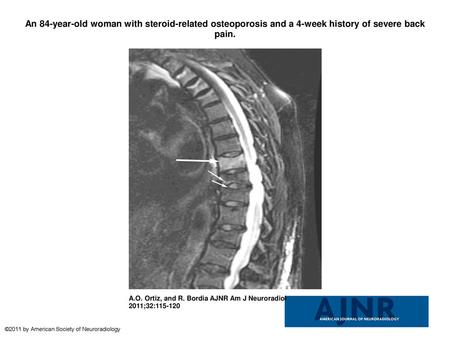 An 84-year-old woman with steroid-related osteoporosis and a 4-week history of severe back pain. An 84-year-old woman with steroid-related osteoporosis.