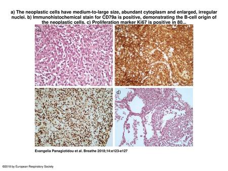 A) The neoplastic cells have medium-to-large size, abundant cytoplasm and enlarged, irregular nuclei. b) Immunohistochemical stain for CD79a is positive,