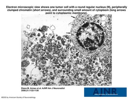 Electron microscopic view shows one tumor cell with a round regular nucleus (N), peripherally clumped chromatin (short arrows), and surrounding small amount.