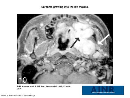 Sarcoma growing into the left maxilla.