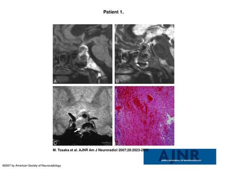 Patient 1. Patient 1. A 65-year-old woman presented with classic pituitary apoplexy manifesting as a sudden onset of severe headache, nausea, vomiting,