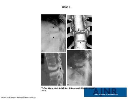 Case 3. Case 3. Diskovertebral erosion, pseudarthrosis, with posterior column involvement.A, Conventional radiograph of the thoracic spine, showing squaring.