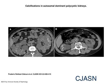 Calcifications in autosomal dominant polycystic kidneys.