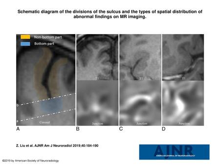 Schematic diagram of the divisions of the sulcus and the types of spatial distribution of abnormal findings on MR imaging. Schematic diagram of the divisions.