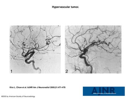 Hypervascular tumor. Hypervascular tumor. Right carotid artery angiogram shows displacement of the branches of the middle cerebral artery. The tumor blush.