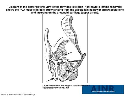 Diagram of the posterolateral view of the laryngeal skeleton (right thyroid lamina removed) shows the PCA muscle (middle arrow) arising from the cricoid.