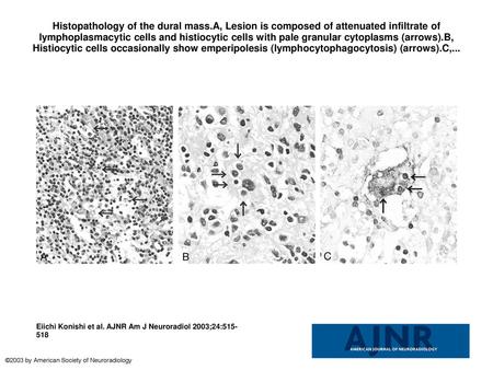 Histopathology of the dural mass