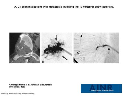 A, CT scan in a patient with metastasis involving the T7 vertebral body (asterisk). A, CT scan in a patient with metastasis involving the T7 vertebral.