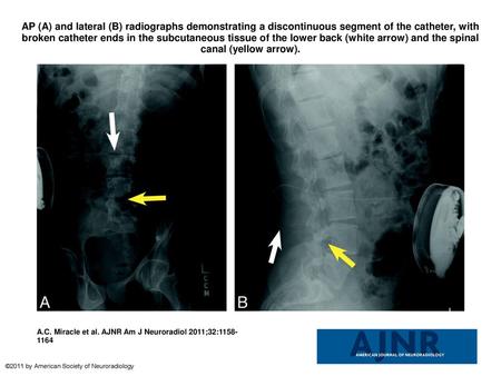 AP (A) and lateral (B) radiographs demonstrating a discontinuous segment of the catheter, with broken catheter ends in the subcutaneous tissue of the lower.