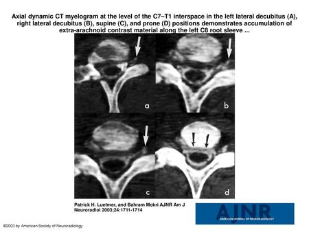 Axial dynamic CT myelogram at the level of the C7–T1 interspace in the left lateral decubitus (A), right lateral decubitus (B), supine (C), and prone (D)