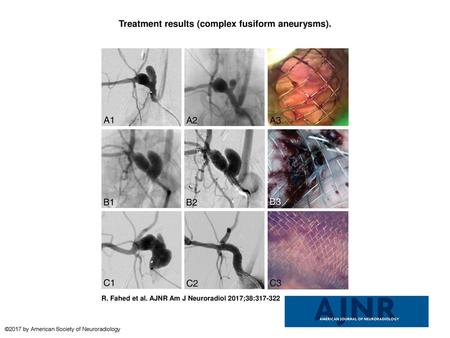 Treatment results (complex fusiform aneurysms).