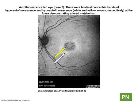 Autofluorescence left eye (case 3)