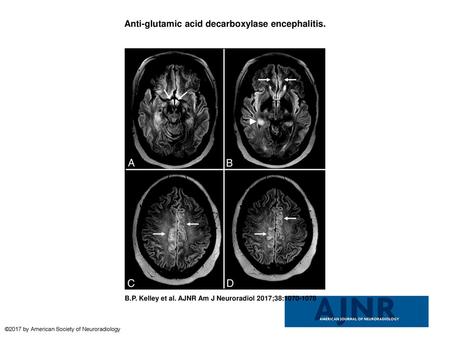 Anti-glutamic acid decarboxylase encephalitis.