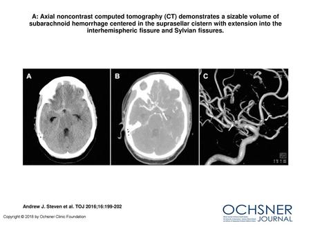 A: Axial noncontrast computed tomography (CT) demonstrates a sizable volume of subarachnoid hemorrhage centered in the suprasellar cistern with extension.