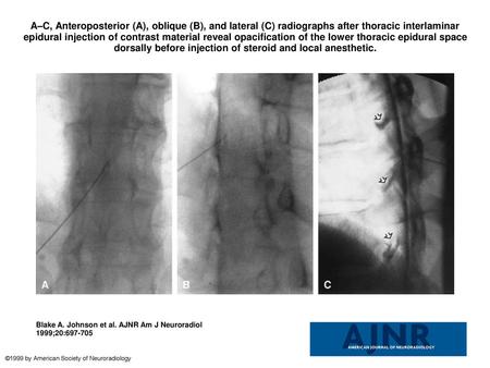 A–C, Anteroposterior (A), oblique (B), and lateral (C) radiographs after thoracic interlaminar epidural injection of contrast material reveal opacification.