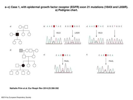 A–c) Case 1, with epidermal growth factor receptor (EGFR) exon 21 mutations (V843I and L858R). a) Pedigree chart. a–c) Case 1, with epidermal growth factor.