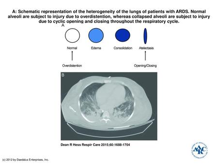 A: Schematic representation of the heterogeneity of the lungs of patients with ARDS. Normal alveoli are subject to injury due to overdistention, whereas.