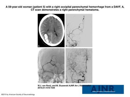 A 59-year-old woman (patient 5) with a right occipital parenchymal hemorrhage from a DAVF. A, CT scan demonstrates a right parenchymal hematoma. A 59-year-old.