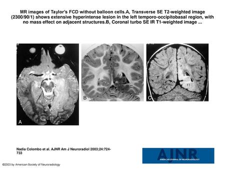 MR images of Taylor’s FCD without balloon cells