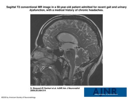 Sagittal T2 conventional MR image in a 50-year-old patient admitted for recent gait and urinary dysfunction, with a medical history of chronic headaches.