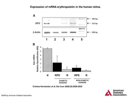 Expression of mRNA erythropoietin in the human retina.