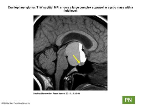 Craniopharyngioma: T1W sagittal MRI shows a large complex suprasellar cystic mass with a fluid level. Craniopharyngioma: T1W sagittal MRI shows a large.