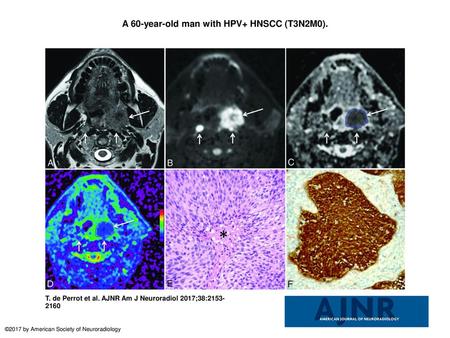 A 60-year-old man with HPV+ HNSCC (T3N2M0).