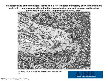 Pathology slide of the meningeal tissue from a left temporal craniotomy shows inflammatory cells with lymphoplasmacytic infiltration, foamy histiocytes,