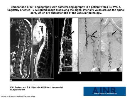 Comparison of MR angiography with catheter angiography in a patient with a SDAVF. A, Sagittally oriented T2-weighted image displaying the signal intensity.