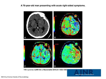 A 76-year-old man presenting with acute right-sided symptoms.