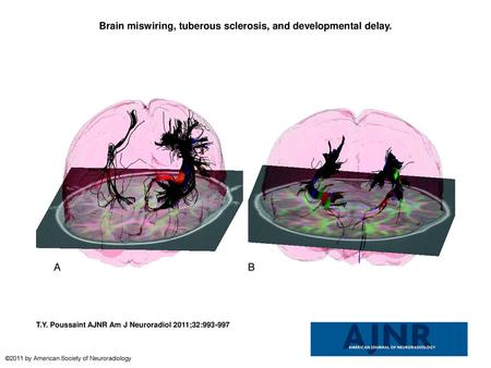 Brain miswiring, tuberous sclerosis, and developmental delay.