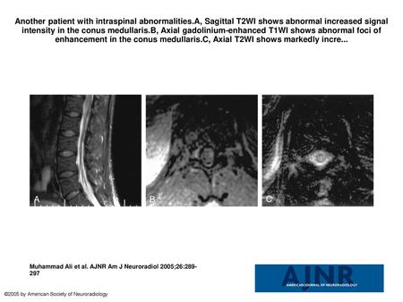 Another patient with intraspinal abnormalities