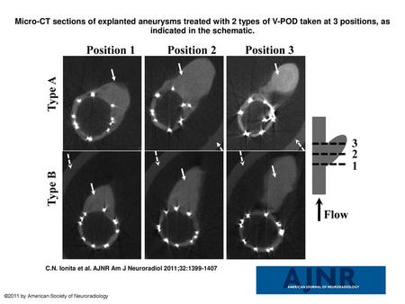 Micro-CT sections of explanted aneurysms treated with 2 types of V-POD taken at 3 positions, as indicated in the schematic. Micro-CT sections of explanted.