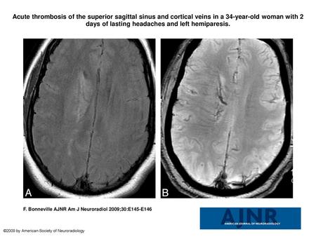 Acute thrombosis of the superior sagittal sinus and cortical veins in a 34-year-old woman with 2 days of lasting headaches and left hemiparesis. Acute.