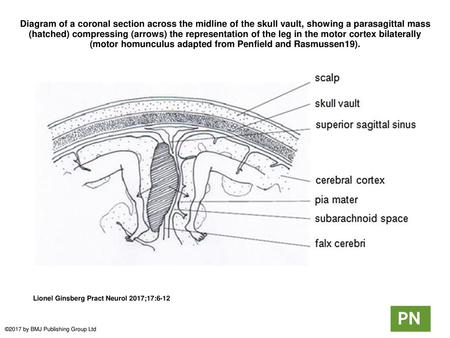 Diagram of a coronal section across the midline of the skull vault, showing a parasagittal mass (hatched) compressing (arrows) the representation of the.