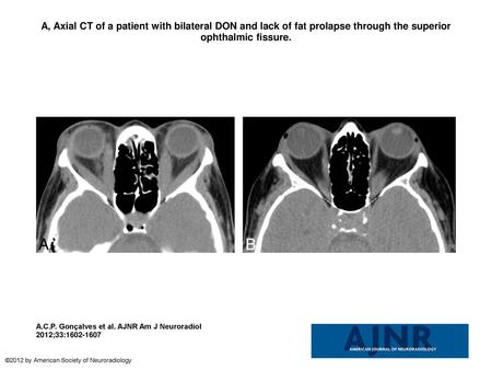 A, Axial CT of a patient with bilateral DON and lack of fat prolapse through the superior ophthalmic fissure. A, Axial CT of a patient with bilateral DON.