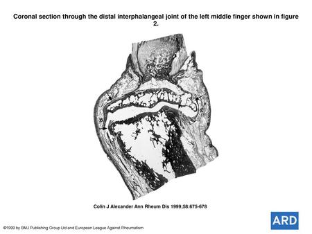 Coronal section through the distal interphalangeal joint of the left middle finger shown in figure 2. Coronal section through the distal interphalangeal.