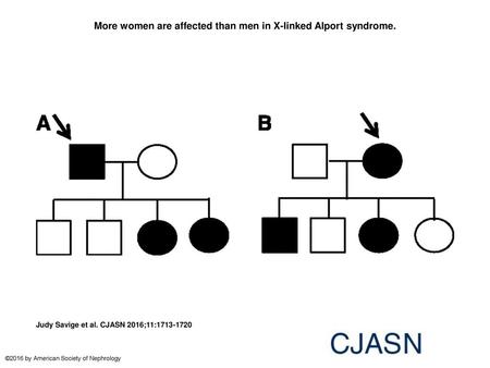 More women are affected than men in X-linked Alport syndrome.