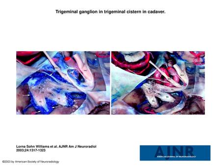 Trigeminal ganglion in trigeminal cistern in cadaver.