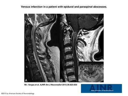 Venous infarction in a patient with epidural and paraspinal abscesses.