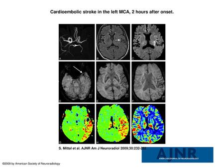 Cardioembolic stroke in the left MCA, 2 hours after onset.