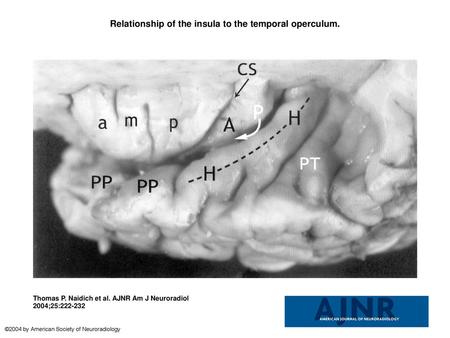 Relationship of the insula to the temporal operculum.