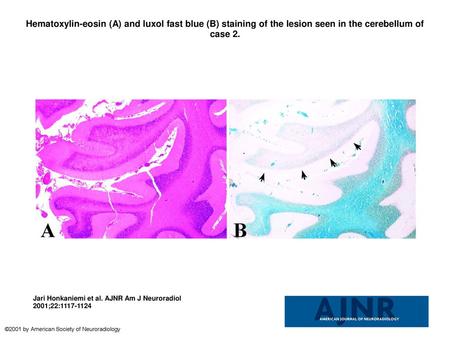 Hematoxylin-eosin (A) and luxol fast blue (B) staining of the lesion seen in the cerebellum of case 2. Hematoxylin-eosin (A) and luxol fast blue (B) staining.