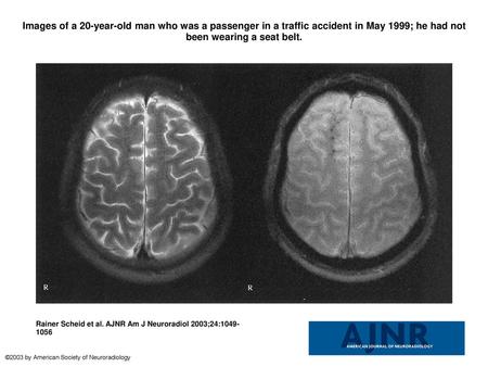 Images of a 20-year-old man who was a passenger in a traffic accident in May 1999; he had not been wearing a seat belt. Images of a 20-year-old man who.