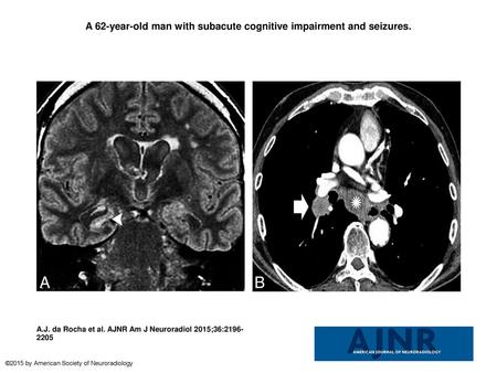 A 62-year-old man with subacute cognitive impairment and seizures.