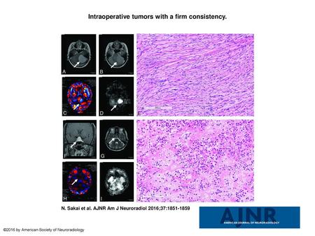 Intraoperative tumors with a firm consistency.